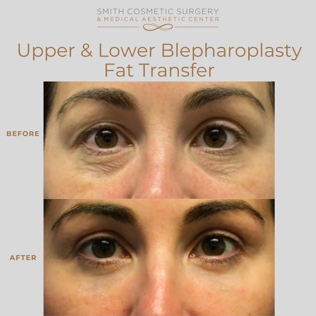 Instagram post by Dr. Cory Bovenzi: Subtle Changes, Powerful Results ✨ Our 38-year-old patient’s transformation focused on a lower blepharoplasty with fat transfer to smooth wr…
