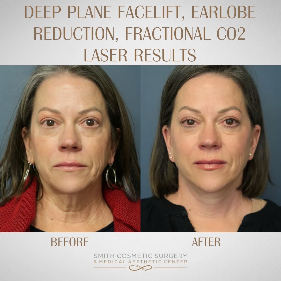 Instagram post by Dr. Cory Bovenzi: At 55, she decided to refresh her look with a Deep Plane Facelift combined with Fractional CO2 laser skin resurfacing. These two procedures …
