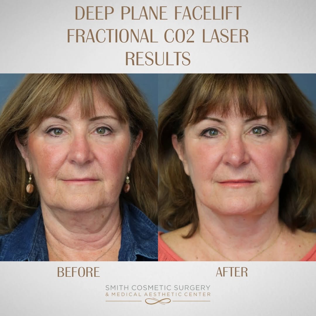 Instagram post by Dr. Cory Bovenzi: ✨Your Beauty, elevated with artistry and expertise! ✨ Our 67-year-old patient came to Dr. Bovenzi concerned about jowls, neck laxity, and ma…