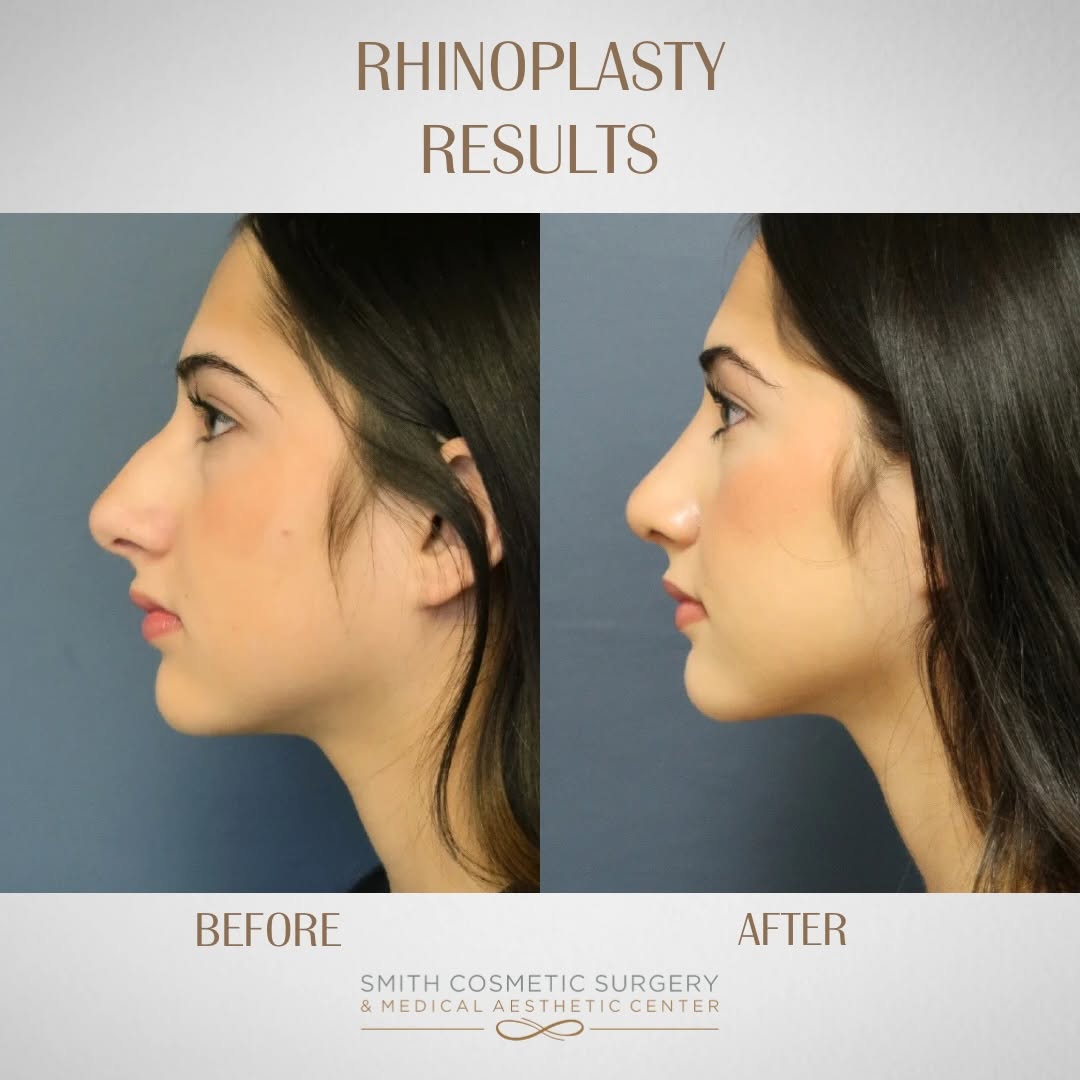 Instagram post by Dr. Cory Bovenzi: 16 years old • 1 month post-op • Rhinoplasty ✨ Just 1 month after surgery, she’s already loving her results. We straightened the nasal bridg…