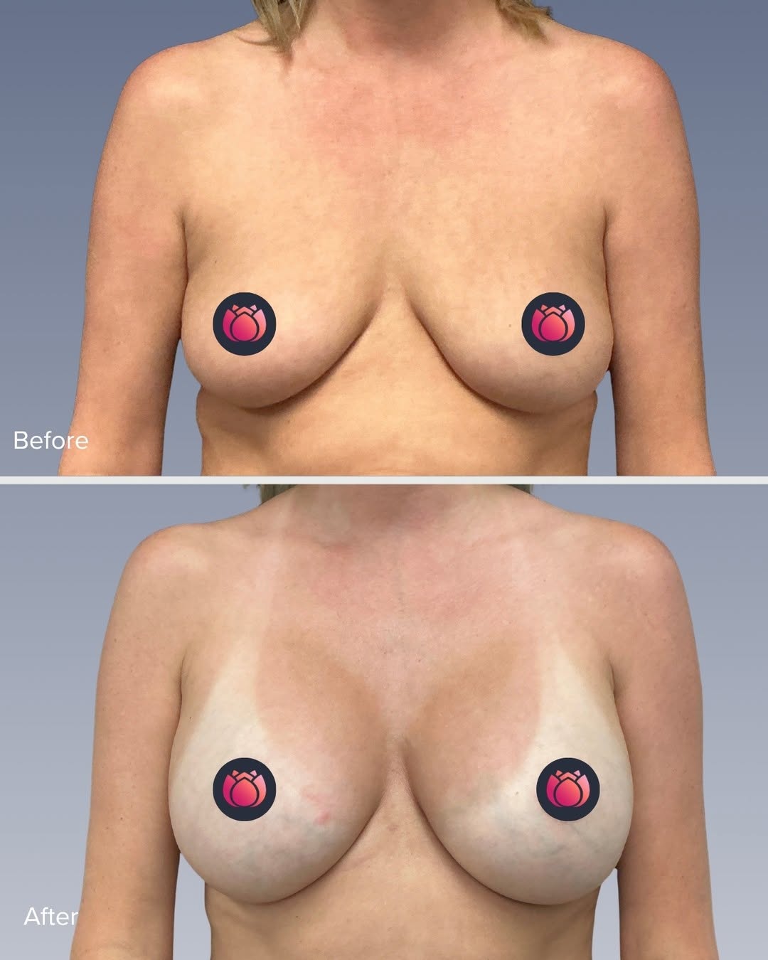 Instagram post by Dr. Courtney Caplin: Before & after breast augmentation 🤍 485cc · Dr. Smith · Oklahoma City Full, balanced, and sized to her frame! If you've been considering y…