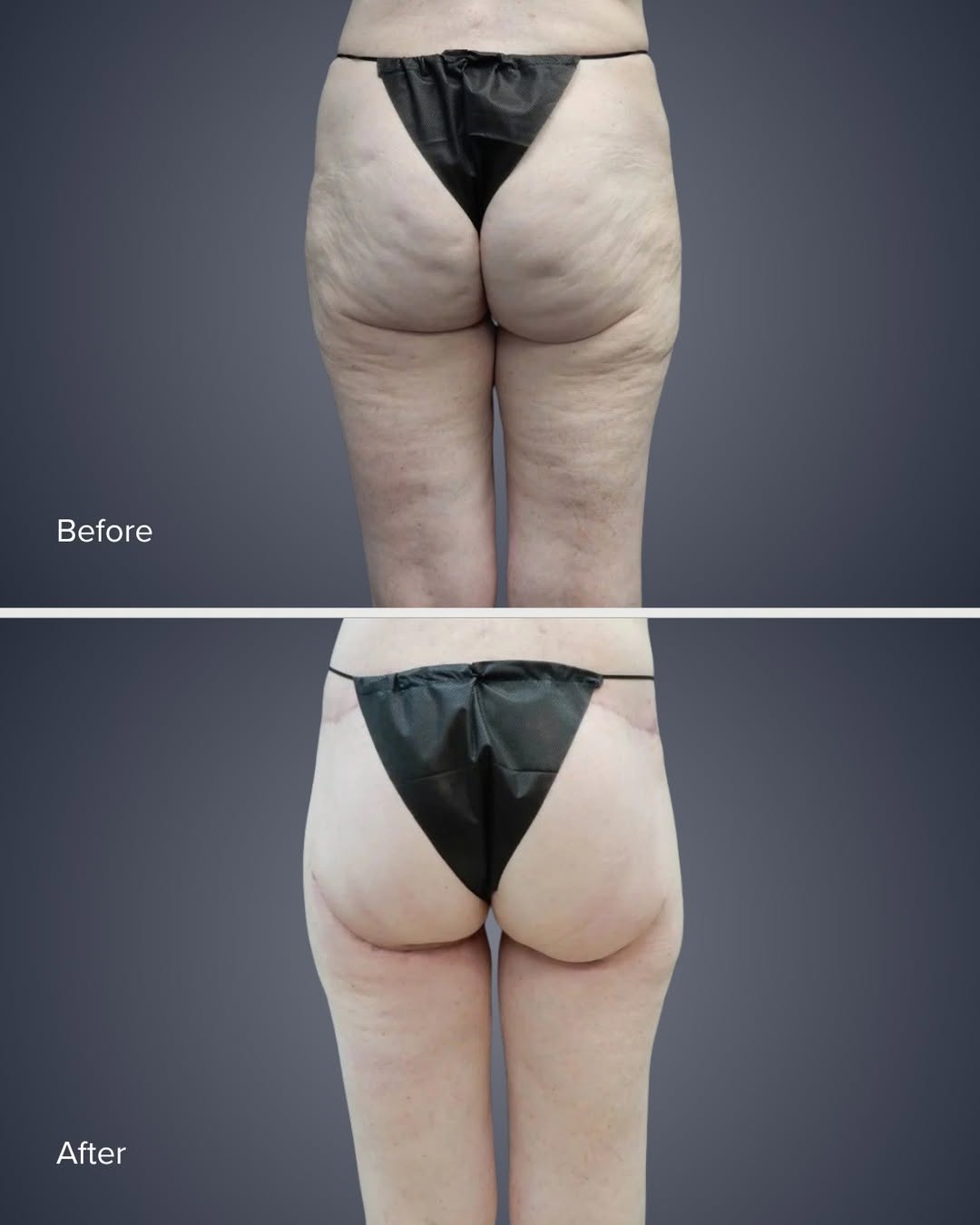 Instagram post by Dr. Courtney Caplin: Thigh lift and butt lift before and after by Dr. Caplin This 58 year old patient came to us with one goal: to feel better in her clothes and…