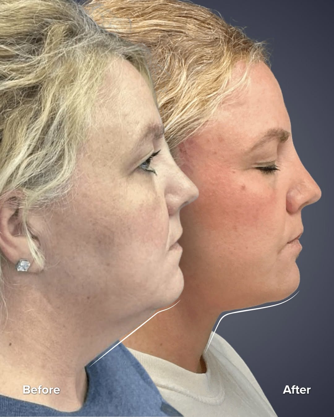 Instagram post by Dr. Courtney Caplin: Before and after SmartLift with Dr. Nuveen 👏 This patient came to us at 53 looking for a more youthful, lifted appearance without the downt…