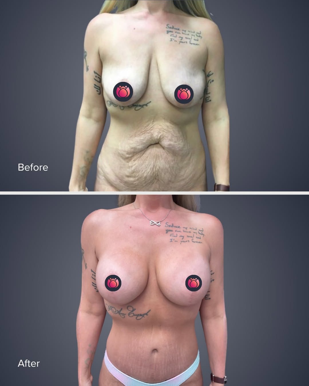 Instagram post by Dr. Courtney Caplin: Before and after mommy makeover by Dr. Caplin 🤍 At 42, this patient came to us with a clear vision: perky, fuller breasts, a tight tummy, a…