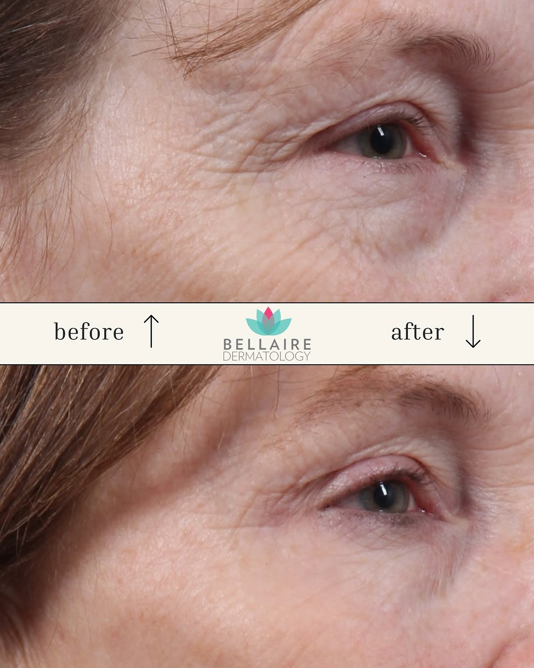 Instagram post by Dr. Craig F. Teller: ✨ Transform your skin with a treatment of Skinvive and Botox! ✨ Skinvive works by boosting hydration and improving skin texture, giving you …