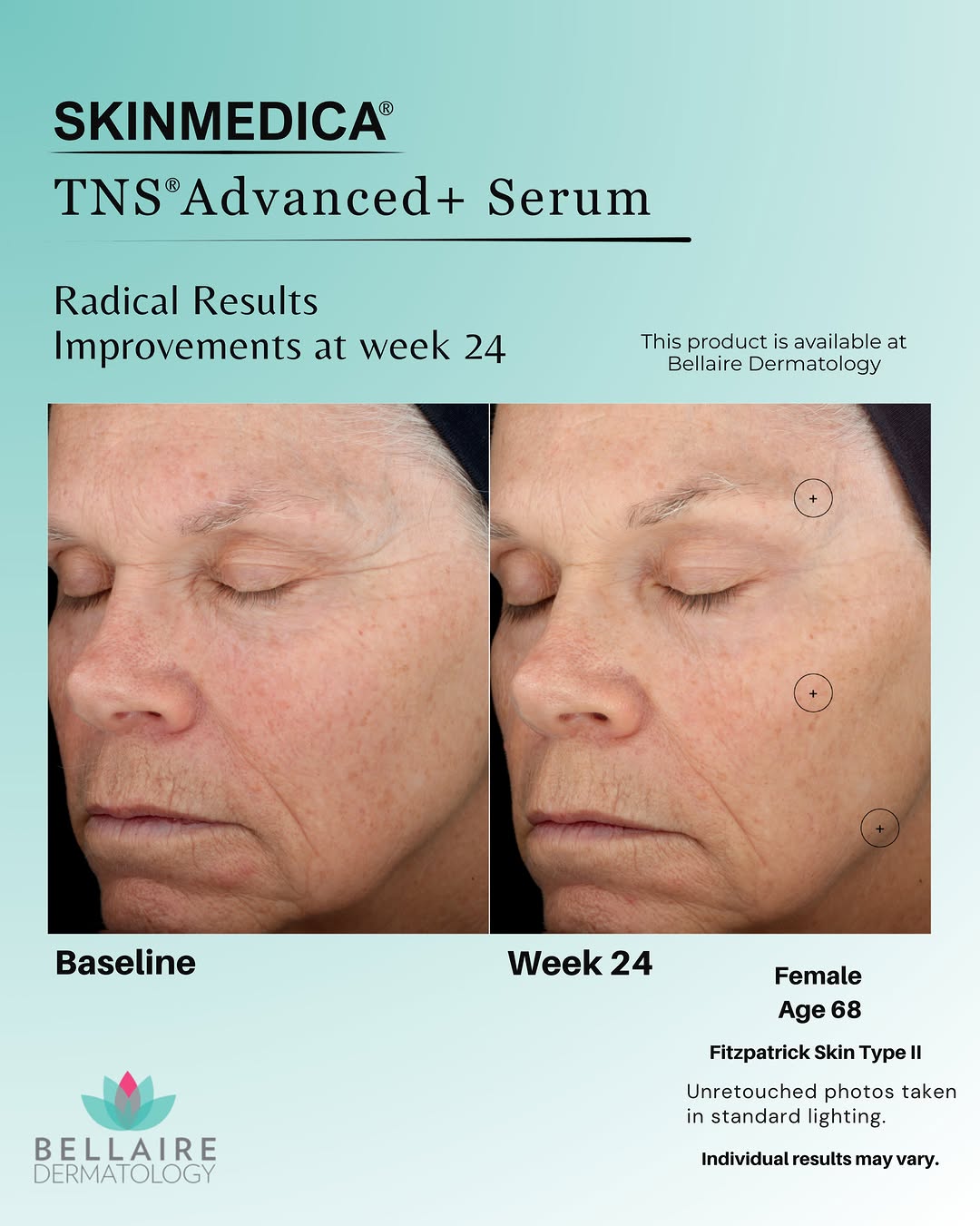 Instagram post by Dr. Craig F. Teller: ❤️🔥If you could only choose ONE anti-aging serum… this would be it. SkinMedica TNS® Advanced+ Serum. If you’re looking for one skincare pr…