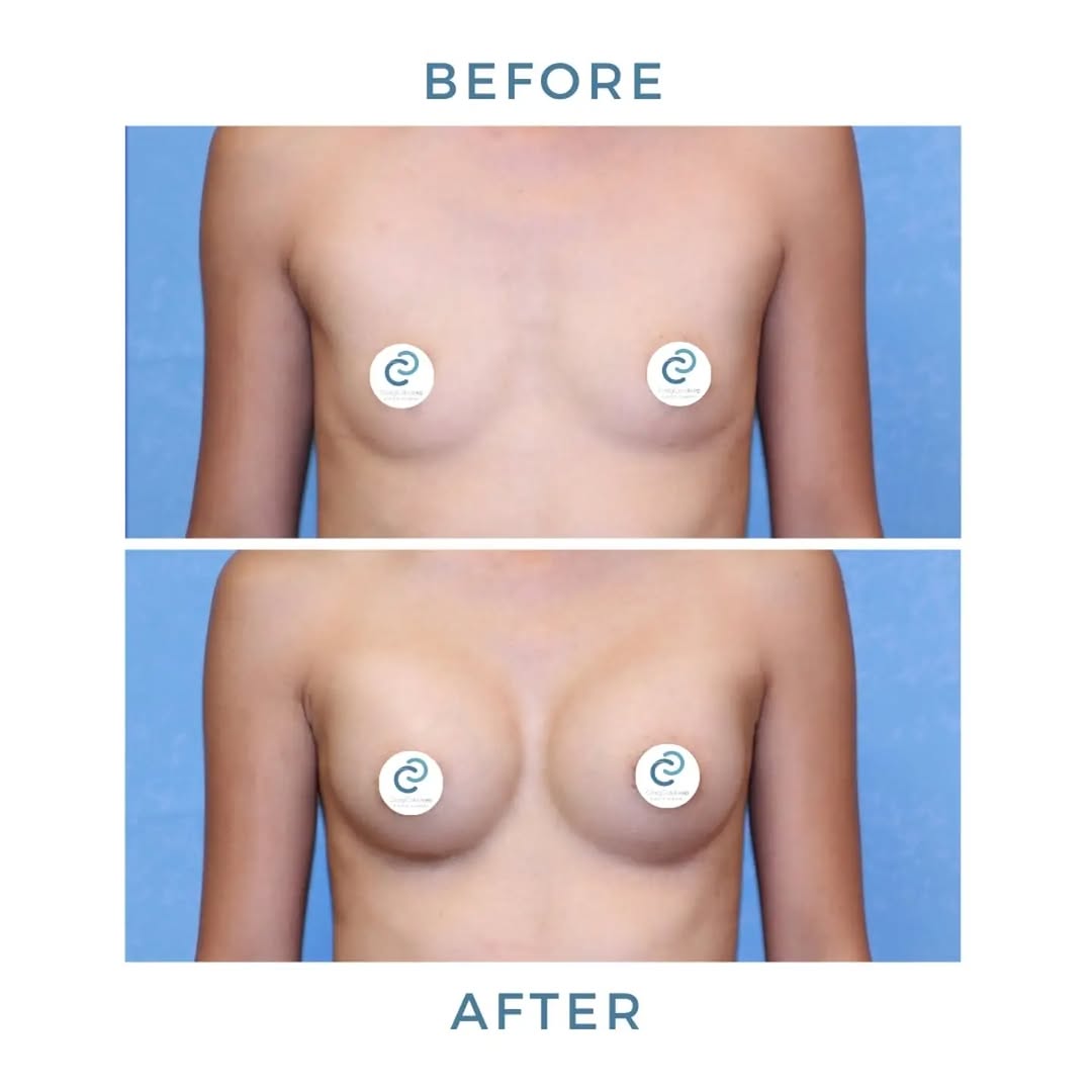 Instagram post by Dr. Craig W. Colville: Subtle change. Beautiful confidence. This patient came to us wanting a natural enhancement—going from a 34A to a look closer to a 34B. With …
