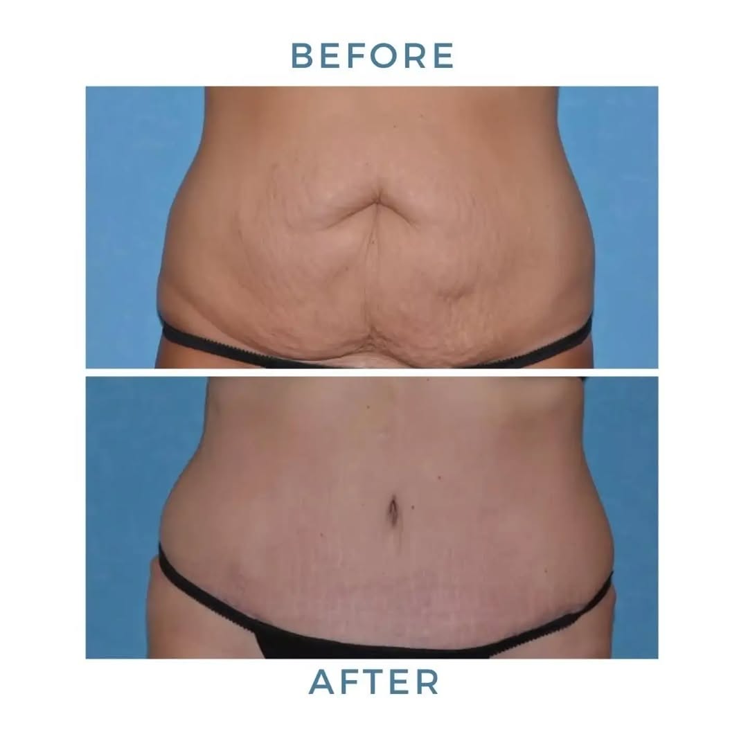 Instagram post by Dr. Craig W. Colville: For those who would like a smoother, flatter midsection, schedule a consultation with me by calling 419.534.6551 & let's discuss if an #Abdo…