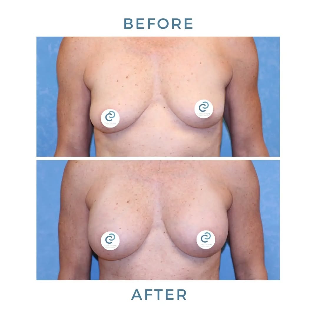 Instagram post by Dr. Craig W. Colville: This patient started as a 34B & wanted a subtle enhancement—just a little more fullness while keeping a natural, balanced look. Her breast a…