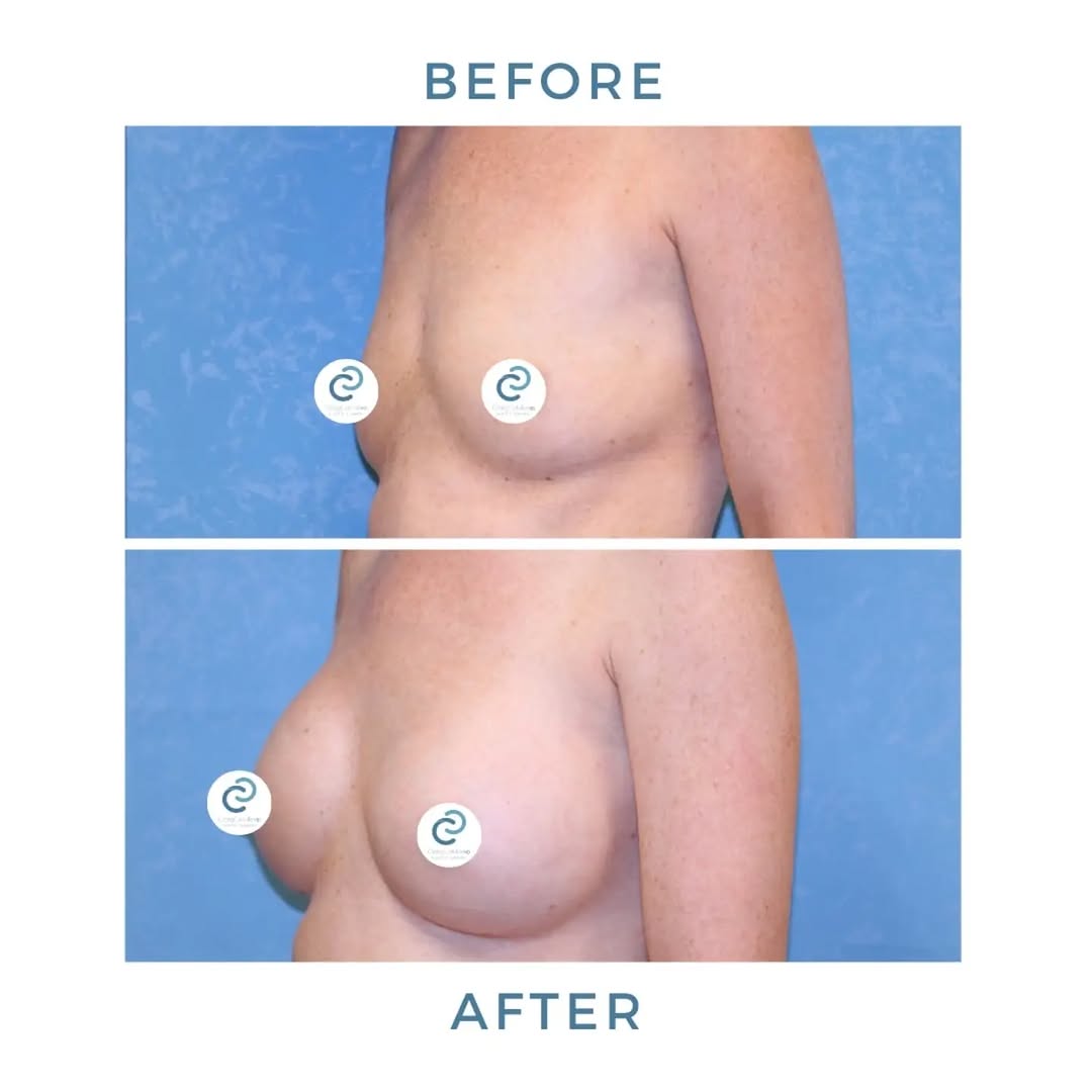 Instagram post by Dr. Craig W. Colville: The goal: fuller, balanced, beautifully natural. This breast augmentation created the shape & proportion she was looking for while complemen…