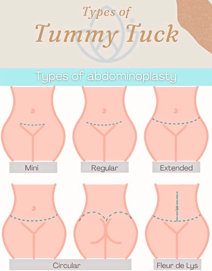 Instagram post by Dr. Cristina Dracea: ɢᴇᴛ ᴛʜᴇ ꜰᴀᴄᴛꜱ ᴏɴ ᴛᴜᴍᴍʏ ᴛᴜᴄᴋꜱ! ✔️ Did you know there are different types of abdominoplasty procedures? From mini to extended, circular to fle…