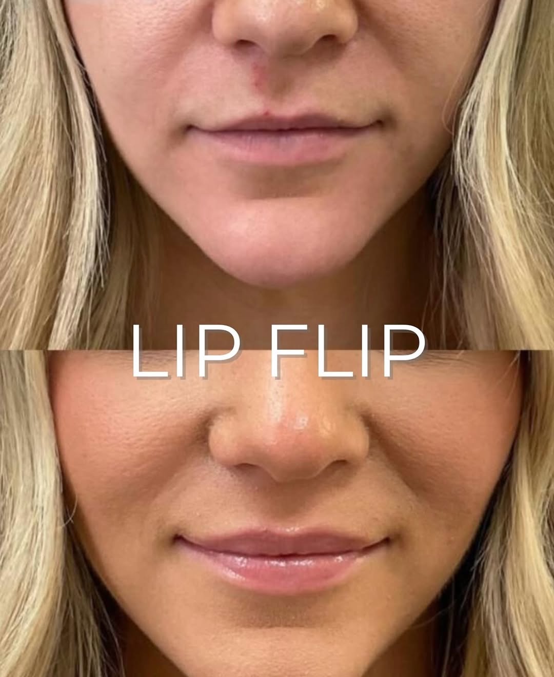 Instagram post by Dr. Cristina Dracea: 👄𝐖𝐡𝐲 𝐬𝐨𝐦𝐞 𝐩𝐚𝐭𝐢𝐞𝐧𝐭𝐬 𝐜𝐨𝐧𝐬𝐢𝐝𝐞𝐫 𝐚 𝐋𝐢𝐩 𝐟𝐥𝐢𝐩 👄 A lip flip with Botox relaxes the muscles around the upper lip, ca…