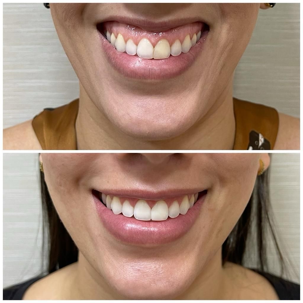 Instagram post by Dr. Cristina Dracea: 👄 𝑩𝒐𝒕𝒐𝒙 𝑮𝒖𝒎𝒎𝒚 𝑺𝒎𝒊𝒍𝒆 👄 Botox for a gummy smile involves injecting small amounts of Botox into the muscles that lift the uppe…