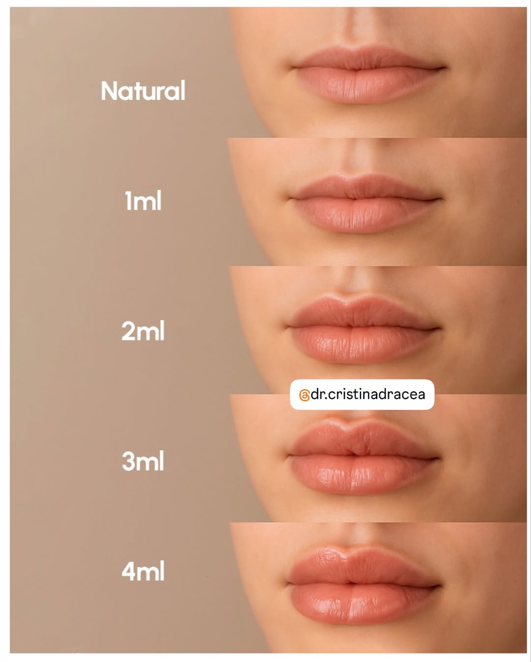 Instagram post by Dr. Cristina Dracea: 👄 When it comes to lip fillers, there’s no “right size”; there’s only your taste and what complements your face. The secret? Technique, com…