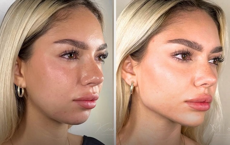 Instagram post by Dr. Cristina Dracea: 𝐌𝐚𝐬𝐬𝐞𝐭𝐞𝐫 𝐁𝐨𝐭𝐨𝐱 𝐒𝐚𝐲 𝐡𝐞𝐥𝐥𝐨 𝐭𝐨 𝐚 𝐛𝐞𝐚𝐮𝐭𝐢𝐟𝐮𝐥𝐥𝐲 𝐛𝐚𝐥𝐚𝐧𝐜𝐞𝐝 𝐩𝐫𝐨𝐟𝐢𝐥𝐞 💉 jawline-slimming Botox treat…