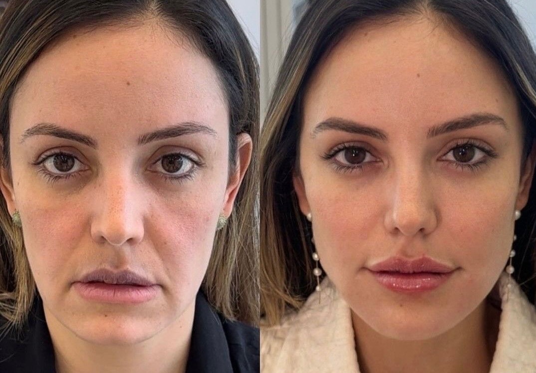Instagram post by Dr. Cristina Dracea: 💓 𝑪𝒐𝒓𝒓𝒆𝒄𝒕𝒊𝒏𝒈 𝒂 𝑫𝒐𝒘𝒏𝒕𝒖𝒓𝒏 𝑺𝒎𝒊𝒍𝒆 𝒘𝒊𝒕𝒉 𝑩𝒐𝒕𝒐𝒙 💉 A downturn smile can affect one’s overall appearance and self-…