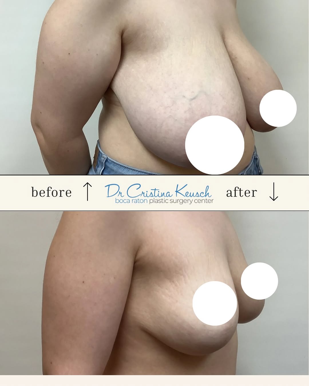 Instagram post by Dr. Cristina F. Keusch: Life-changing transformation ✨ Breast reduction for relief, balance, and confidence, by Dr. Cristina Keusch 🤍 Book your consultation today.…