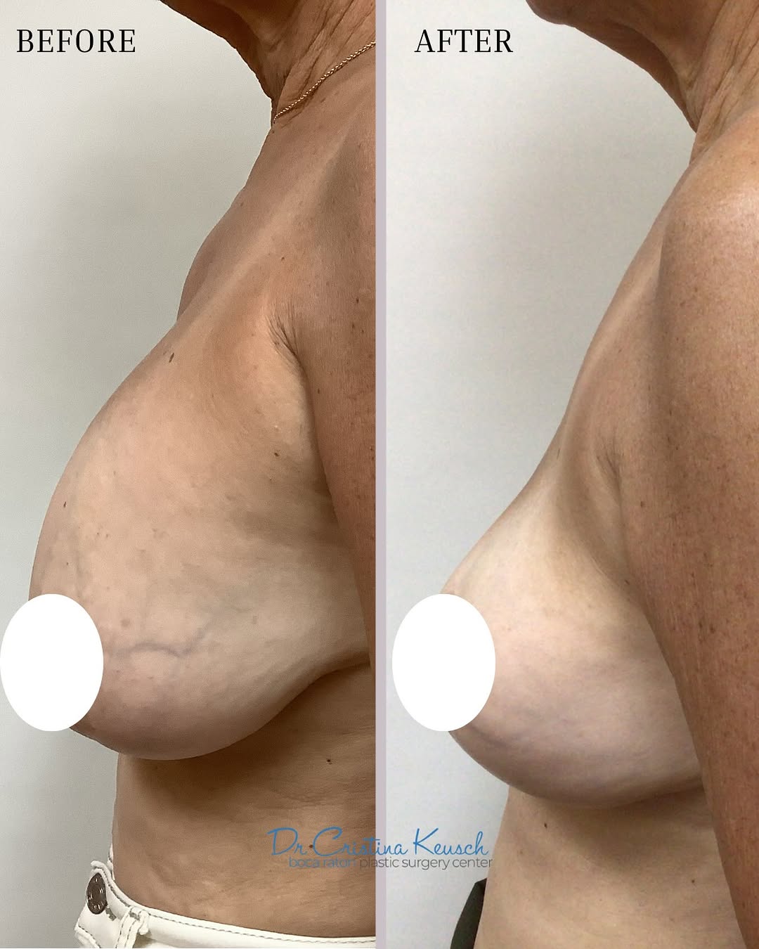 Instagram post by Dr. Cristina F. Keusch: Implant removal + Lejour mastopexy by Dr. Cristina Keusch ✨ A beautiful transformation using a lollipop incision only—no anchor scar—lifting…