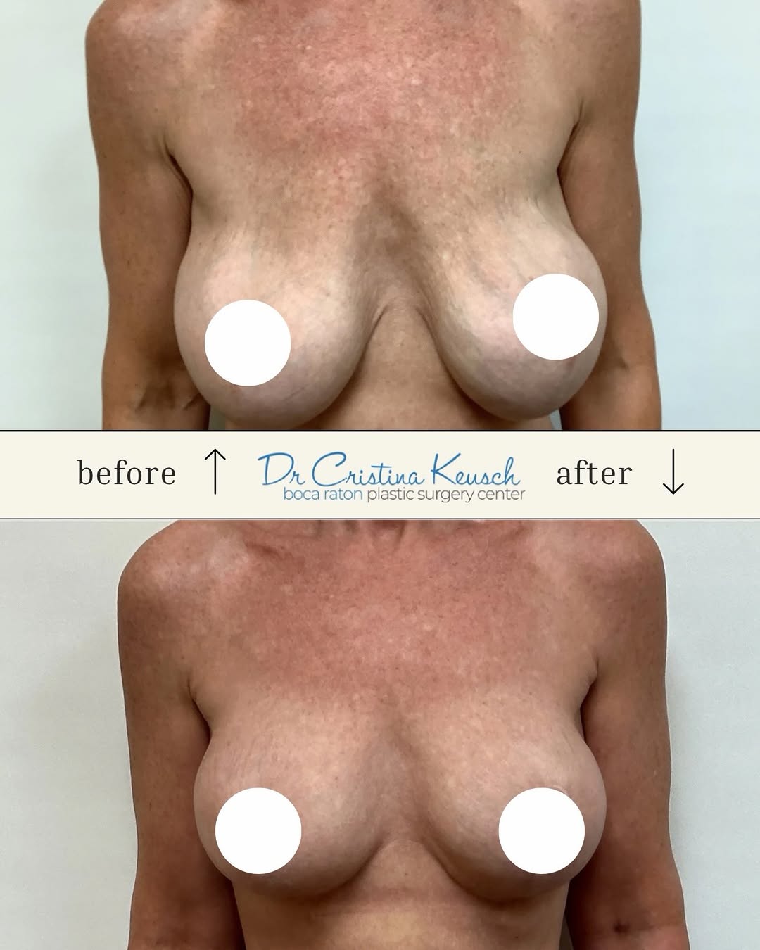 Instagram post by Dr. Cristina F. Keusch: Beautiful, lifted, natural looking results performed by double board certified plastic surgeon, Dr. Cristina Keusch. Call to schedule your b…