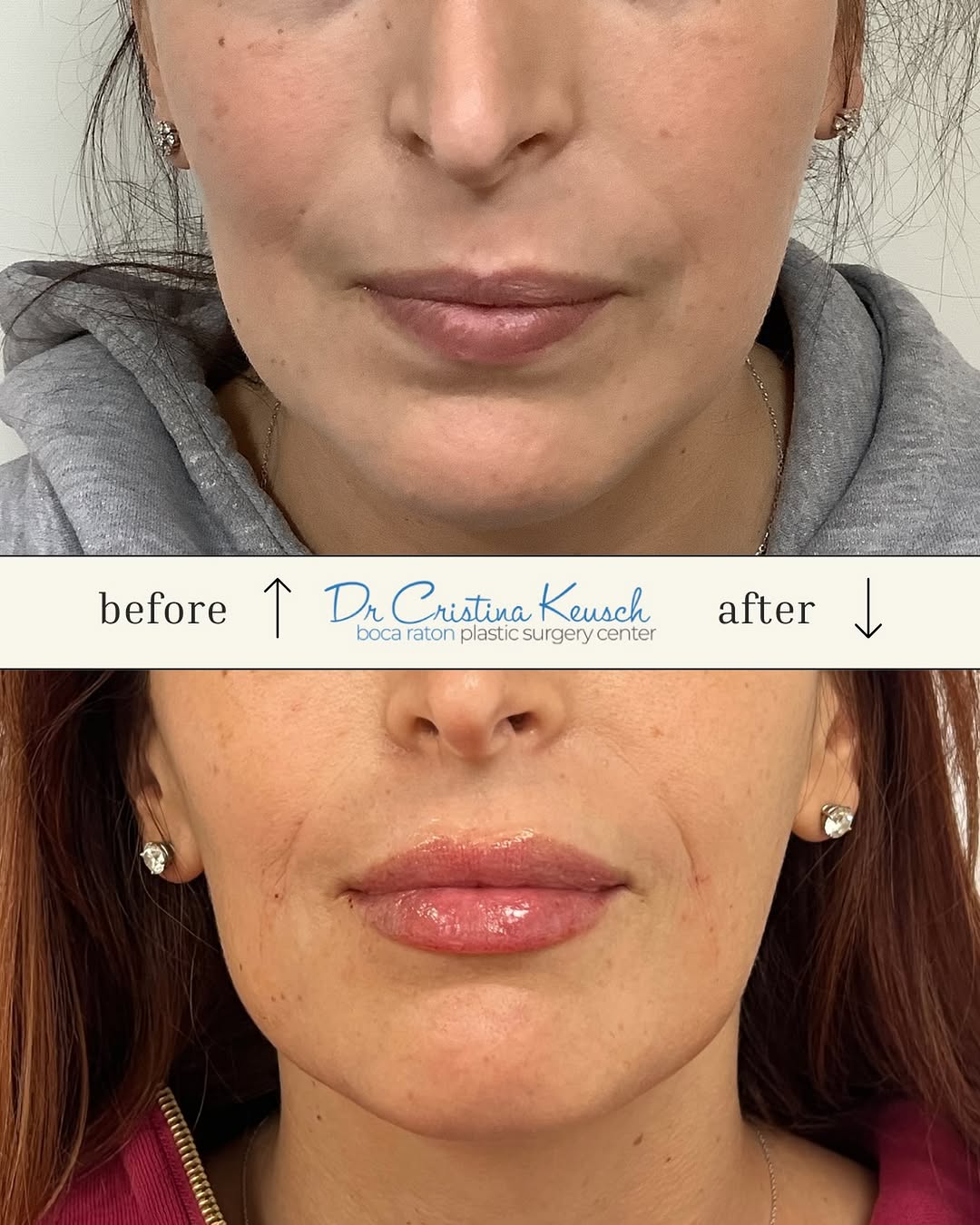 Instagram post by Dr. Cristina F. Keusch: ✨ Perfectly plump, naturally defined lips 💋 Lip filler by Allyson, APRN 📞 Call 561-368-9455 to schedule your consultation!