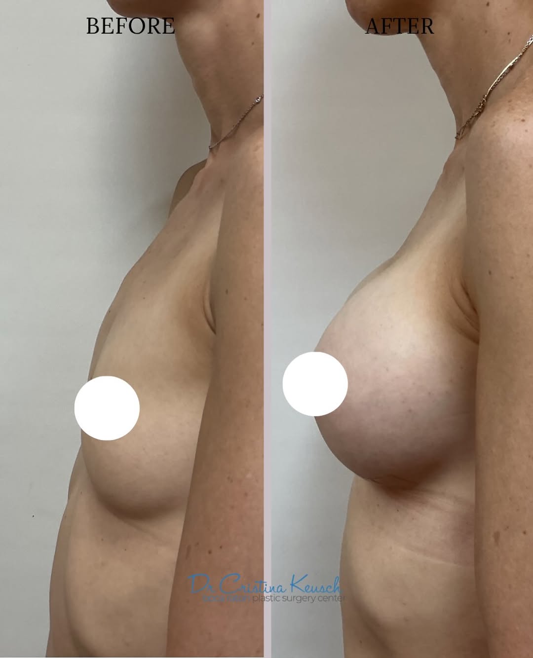Instagram post by Dr. Cristina F. Keusch: ✨ Breast Augmentation Before & After ✨ Beautiful, natural-looking enhancement by Dr. Cristina Keusch—creating fuller volume, improved shape,…