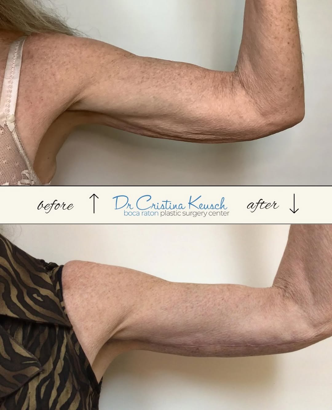 Instagram post by Dr. Cristina F. Keusch: ✨ Brachioplasty Before & After ✨ Smoother, more defined arms after an arm lift by Dr. Cristina Keusch. 📲 Ready to learn more? Call 561-368-…