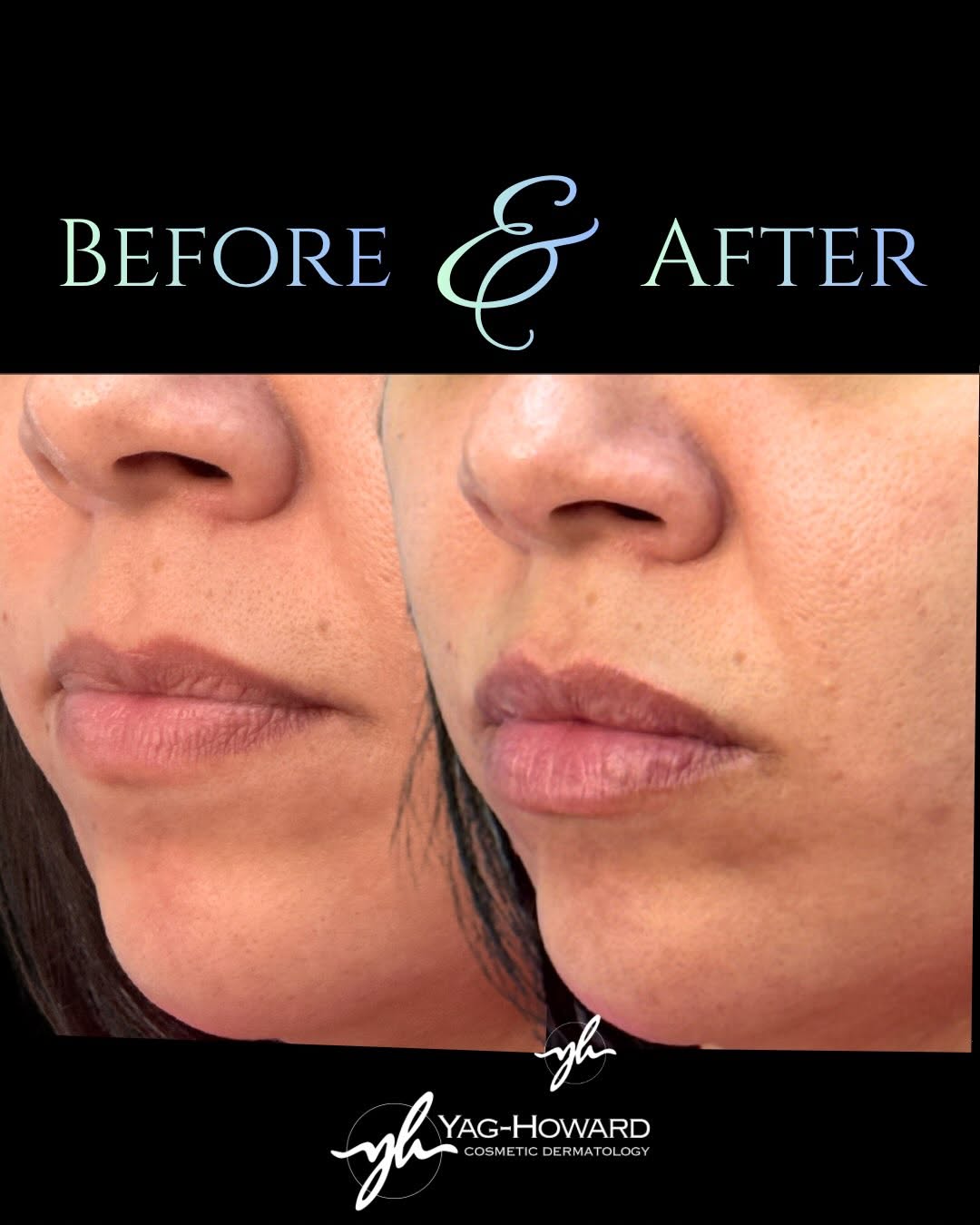 Instagram post by Dr. Cyndi Yag-Howard: 1 syringe. Immediately after. Still soft. Still her. Natural doesn’t always mean doing less. It means doing it well. The right product, the …