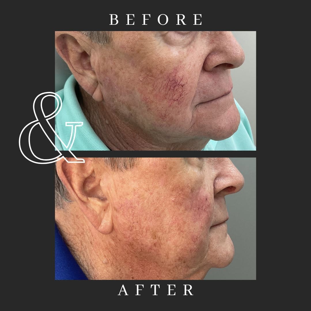 Instagram post by Dr. Cyndi Yag-Howard: Broken vessels on the face can be eliminated in just one visit. This simple procedure makes such a difference for men and women. Schedule a …