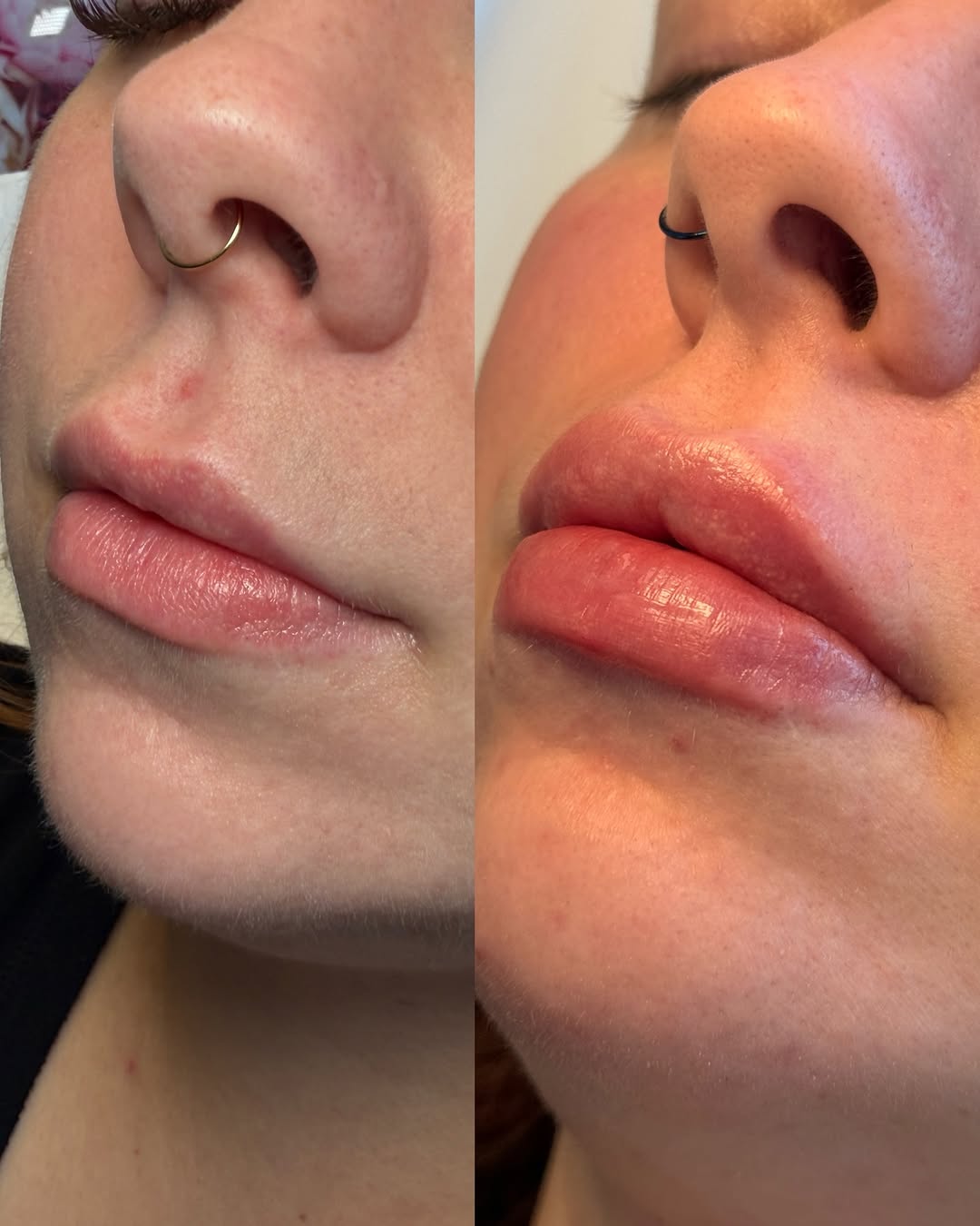 Instagram post by Dr. Cynthia D. Gray: Before & after two half syringe treatments over the span of a year💓 *injected by Sydney, RN *swelling typically subsides in 2-3 weeks 📍 @s…