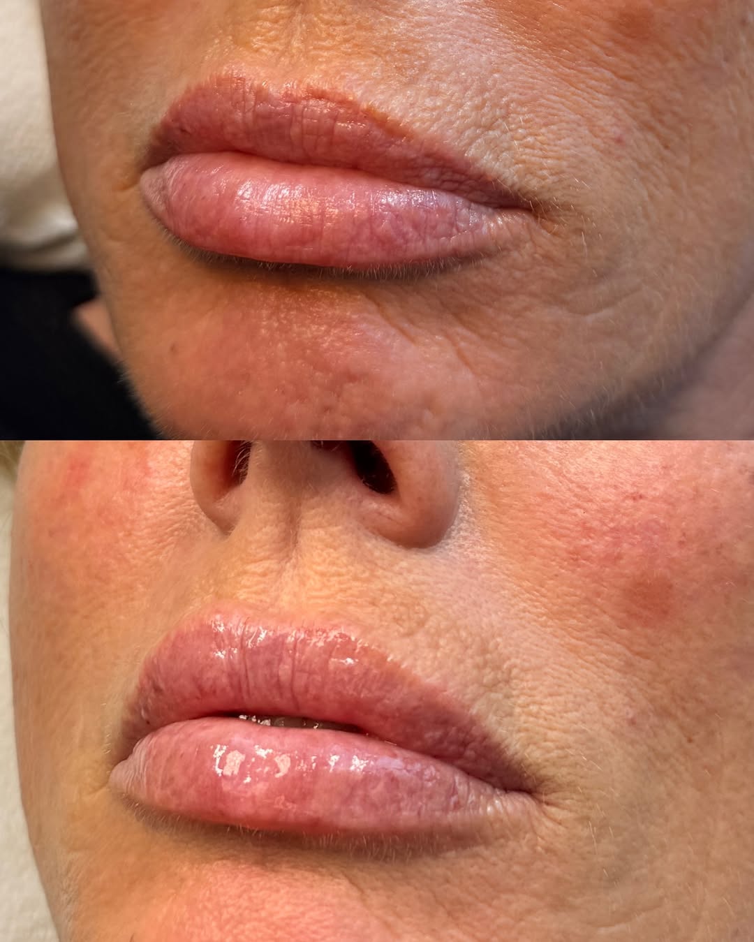 Instagram post by Dr. Cynthia D. Gray: 1/2 syringe maintenance on this lovely 🫶 *injected by Sydney, RN *swelling typically subsides in 2-3 weeks 📍 @spabella_med ☎️ (360)892-009…