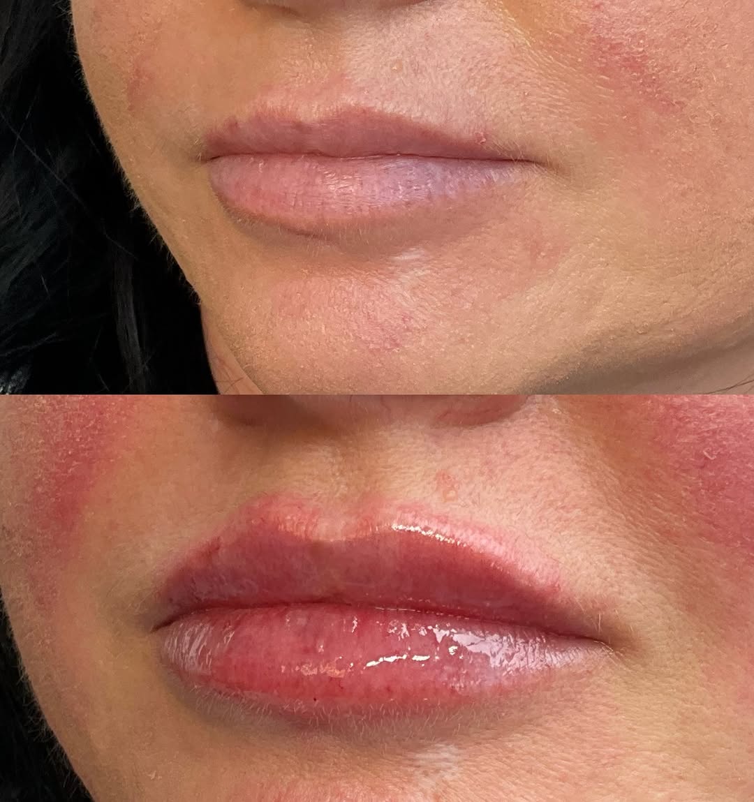 Instagram post by Dr. Cynthia D. Gray: Natural lip filler using Juvederm Ultra 💓 *injected by Sydney, RN *swelling typically subsides in 2-3 weeks 📍 @spabella_med ☎️ (360)892-00…