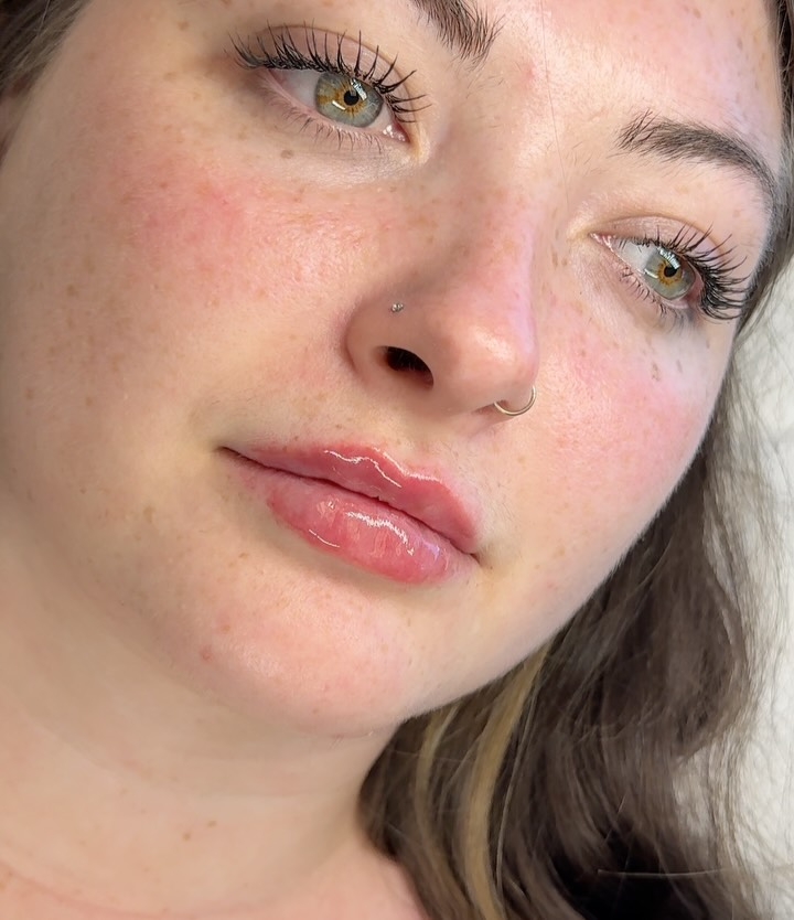 Instagram post by Dr. Cynthia D. Gray: 2nd session with this gem 💓 Using Juvederm ultra plus 💉 *injected by Sydney, RN *swelling typically subsides in ~2 weeks 📍 @spabella_med …