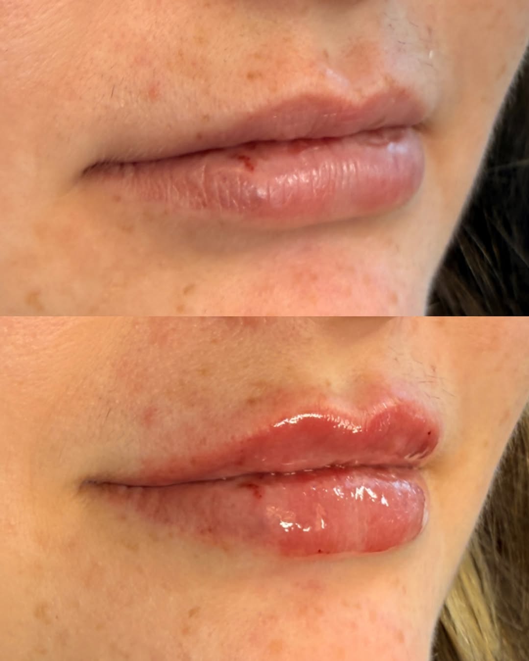Instagram post by Dr. Cynthia D. Gray: Adore this transformation 🤩 Half syringe of juvederm ultra with another half in the books 💓 lips take time to build!! *injected by Sydney,…