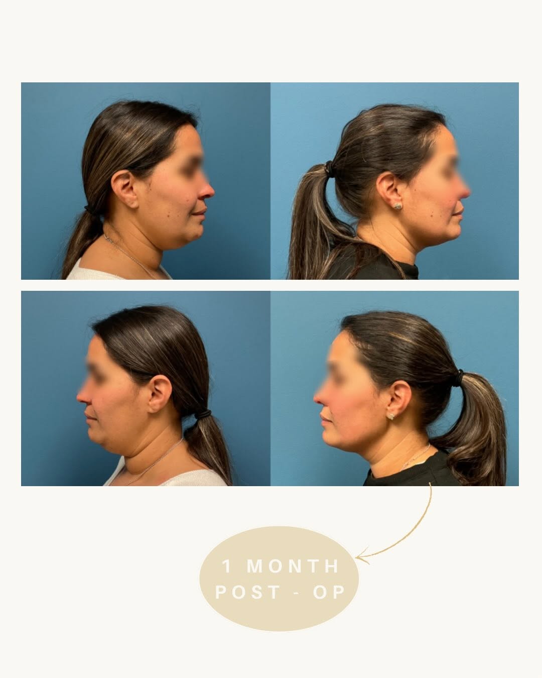 Instagram post by Dr. Cynthia Diehl: If a “double chin” has been bothering you, this is your sign🤍 These results are only 1️⃣ month post submental liposuction… imagine what’s s…