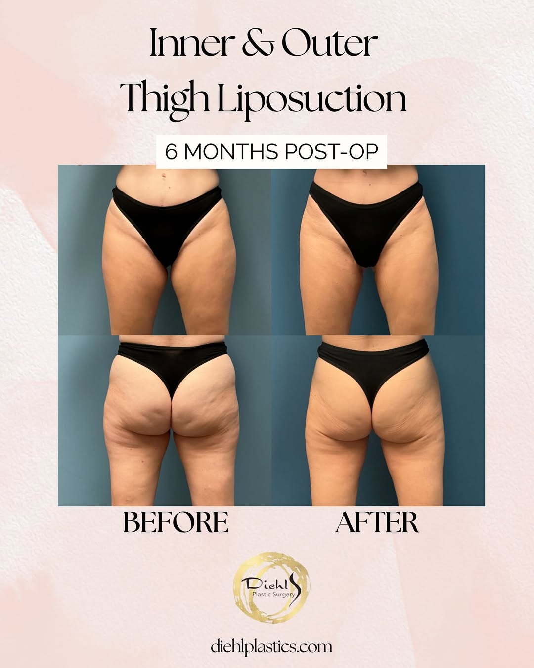 Instagram post by Dr. Cynthia Diehl: These results are only 6️⃣ months post-op after inner & outer thigh liposuction. The difference in contour, shaped and proportion is incredi…