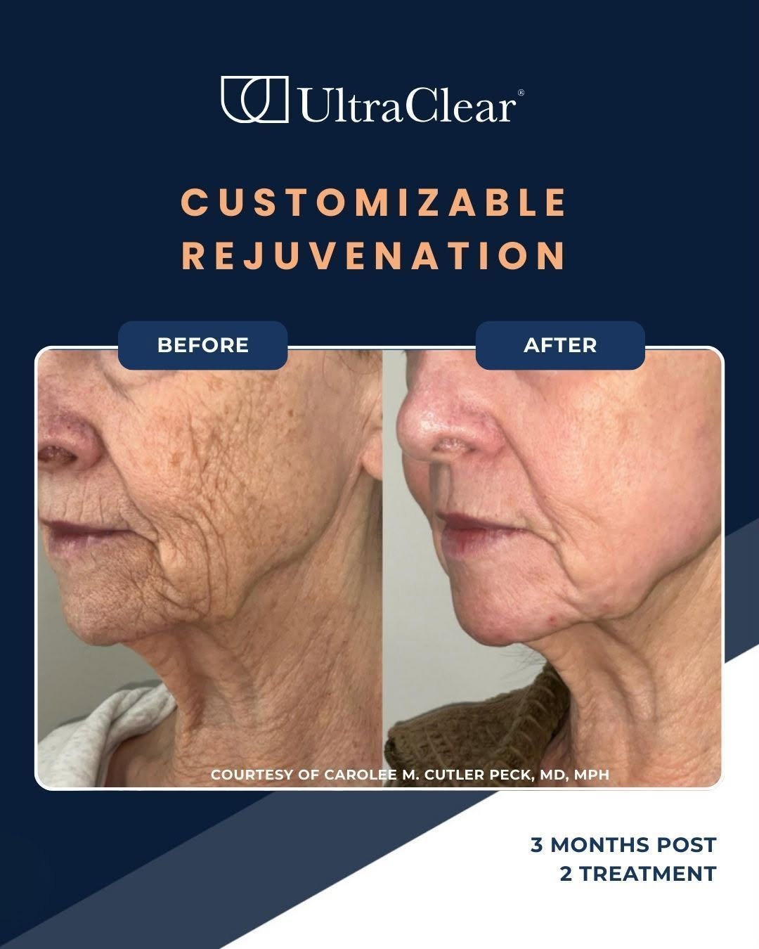 Instagram post by Dr. Cynthia Golomb: UltraClear® is a cold ablative fractional laser that optimizes energy delivery without excessive heat damage – targeting deep layers while p…