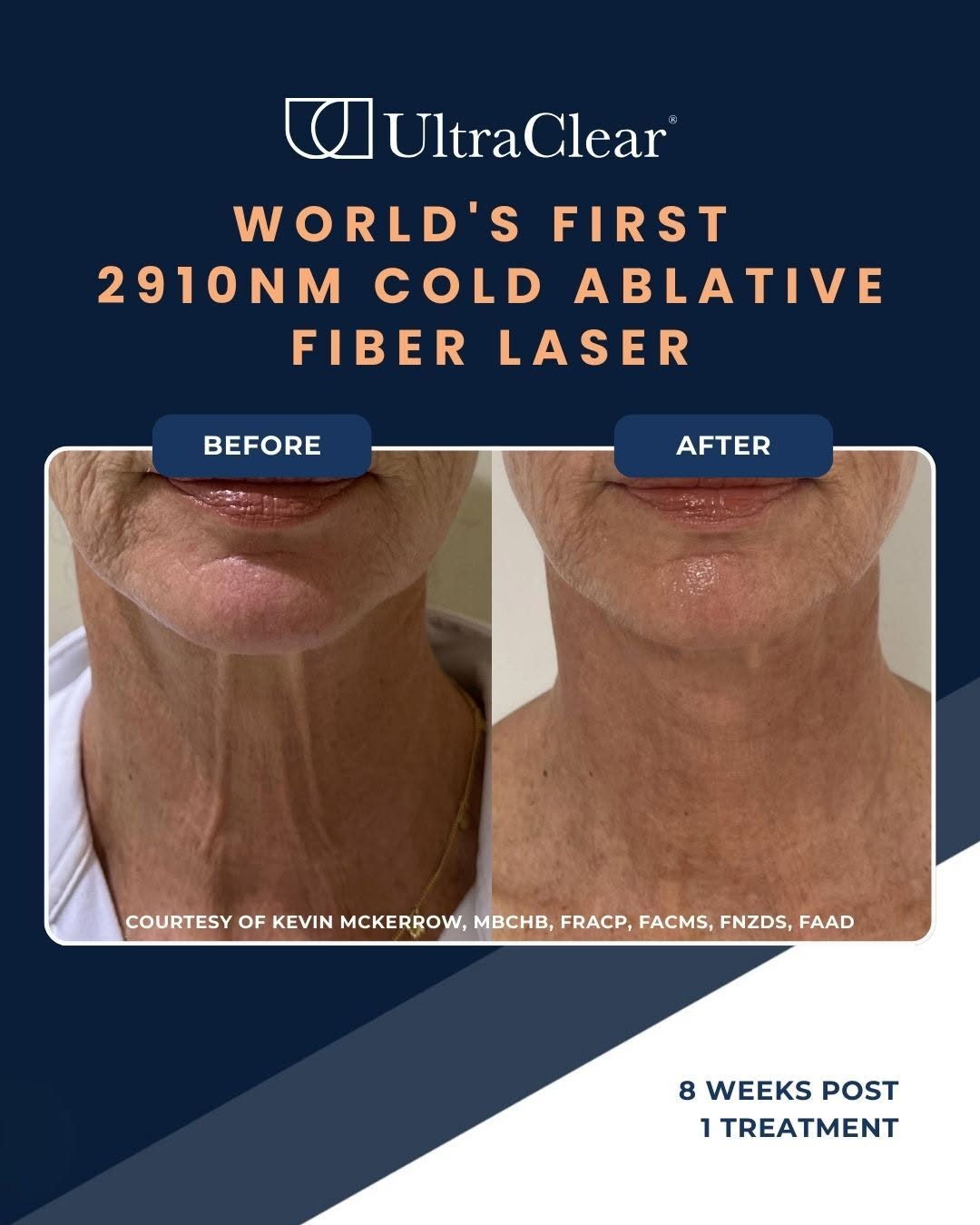 Instagram post by Dr. Cynthia Golomb: My new UltraClear laser treats fine lines, wrinkles, uneven tone and texture, pigmentation, age spots, sun damage, surgical and acne scars. …