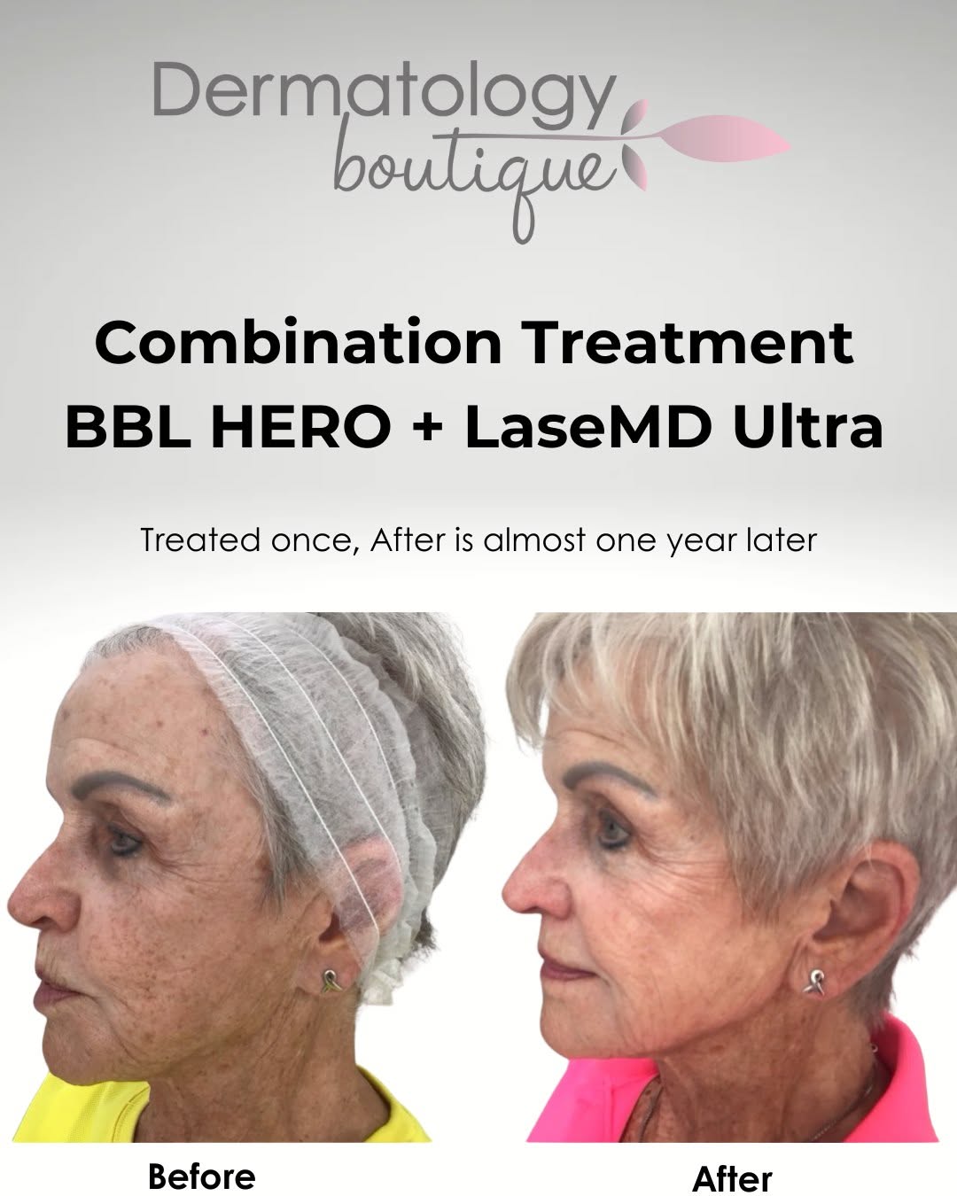 Instagram post by Dr. Cynthia Golomb: Mylene treated this patient's face with both the BBL HERO and the LaseMD Ultra in one treatment session. The after photo was taken during he…