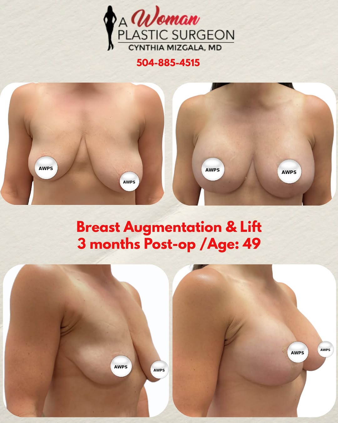 Instagram post by Dr. Cynthia L. Mizgala: ✨ 3 Months Post-Op ✨ This beautiful 49-year-old mother of two wanted to improve breast asymmetry, restore fullness, and achieve a more lifte…