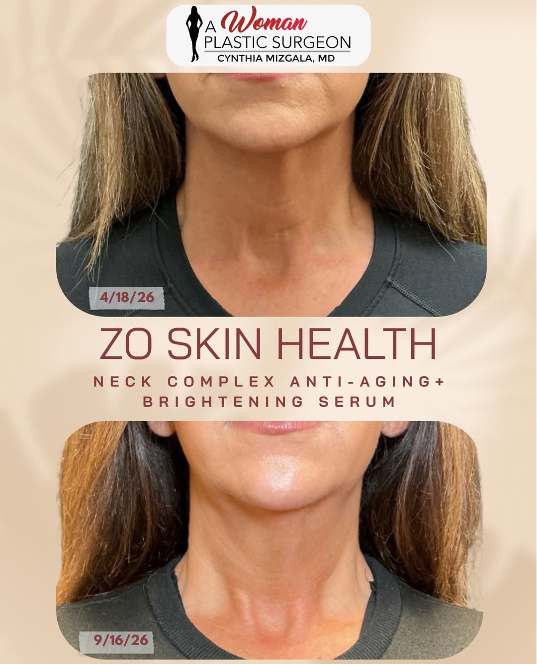 Instagram post by Dr. Cynthia L. Mizgala: ✨ The progress continues! ✨ We shared her 2-month results before, but we had to show you what consistent skincare can do. From April to toda…