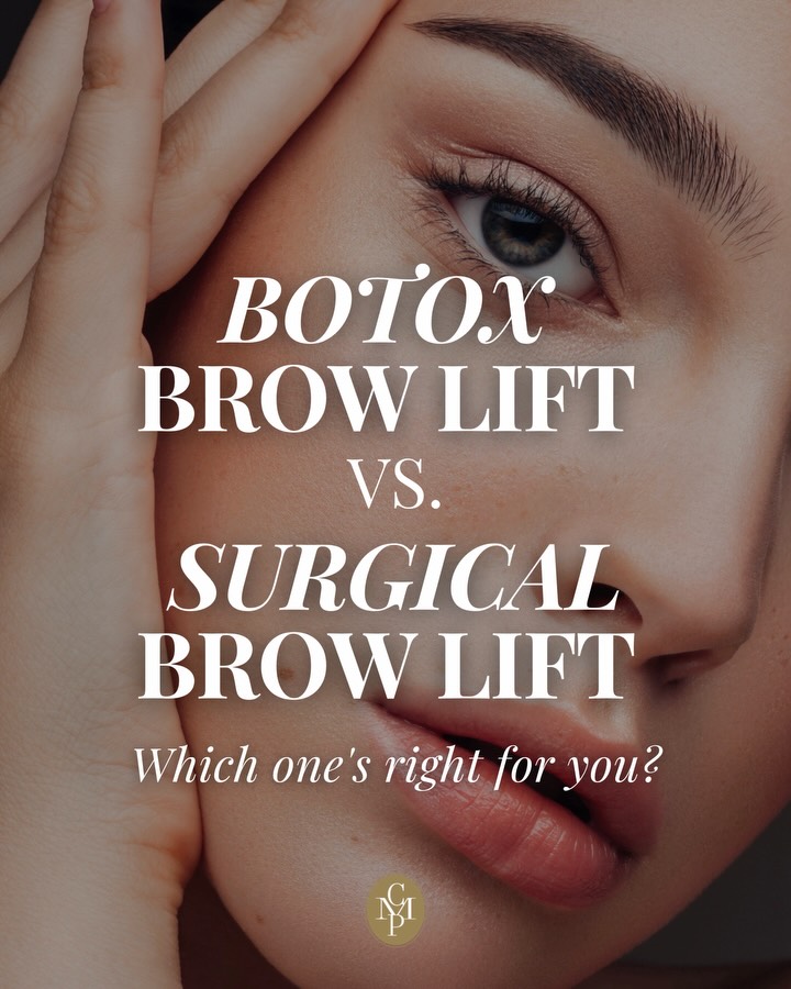 Instagram post by Dr. Cynthia M. Poulos: Not sure which brow lift is right for you? Here’s the breakdown. 🤍 Botox and surgical brow lifts can both open the eyes and soften a heavy …
