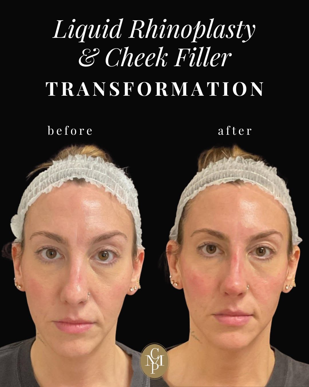 Instagram post by Dr. Cynthia M. Poulos: Refined profile, balanced contours, beautiful results. ✨ This patient’s non-surgical transformation was achieved with a customized combinati…