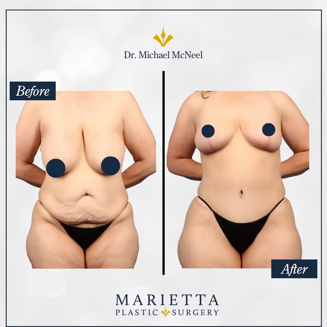 Instagram post by Dr. D. Keith West: It’s the kind of transformation where every detail matters. 👏 Dr. McNeel combined an extended tummy tuck with muscle plication, breast lift…