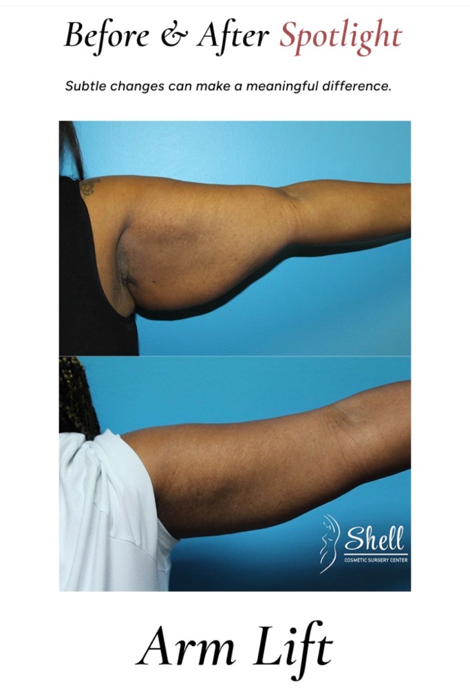 Instagram post by Dr. Dan H. Shell III: ✨ Subtle changes. Meaningful results. ✨ This patient achieved a smoother, more contoured upper arm appearance with a brachioplasty (arm lift…