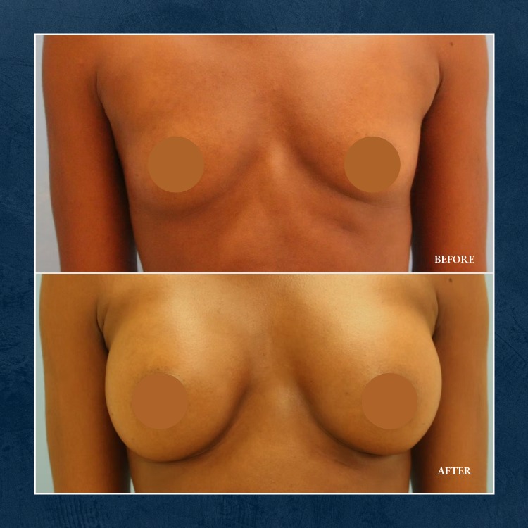 Instagram post by Dr. Dan H. Shell III: ✨ Confidence, enhanced ✨ This patient wanted to restore fullness and achieve a more feminine silhouette—and she couldn’t be happier with her…