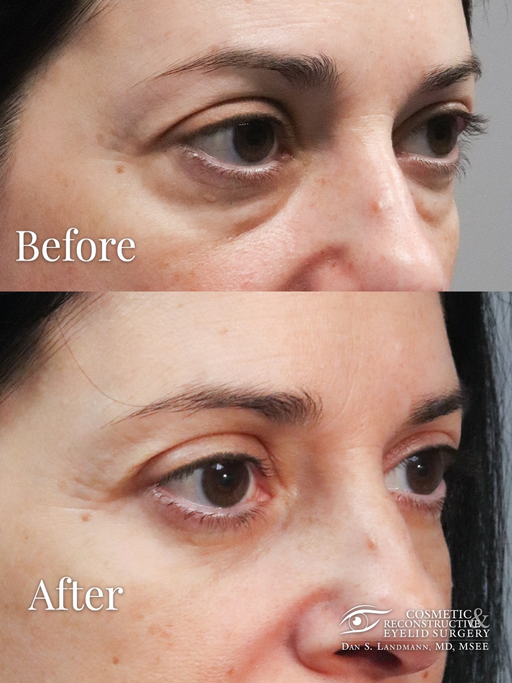 Instagram post by Dr. Dan Landmann: Here’s a fun mom who had bags under her eyes. Now she doesn’t. Do you have bags under your eyes. For a good time, call... Appointments: 📞20…
