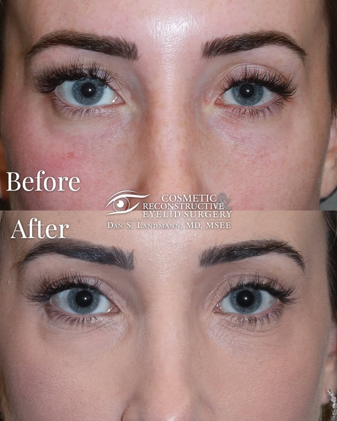 Instagram post by Dr. Dan Landmann: This lovely patient had a mild amount of asymmetry. Her Right Upper Eyelid looked more open, but it had more skin, making it difficult to pu…