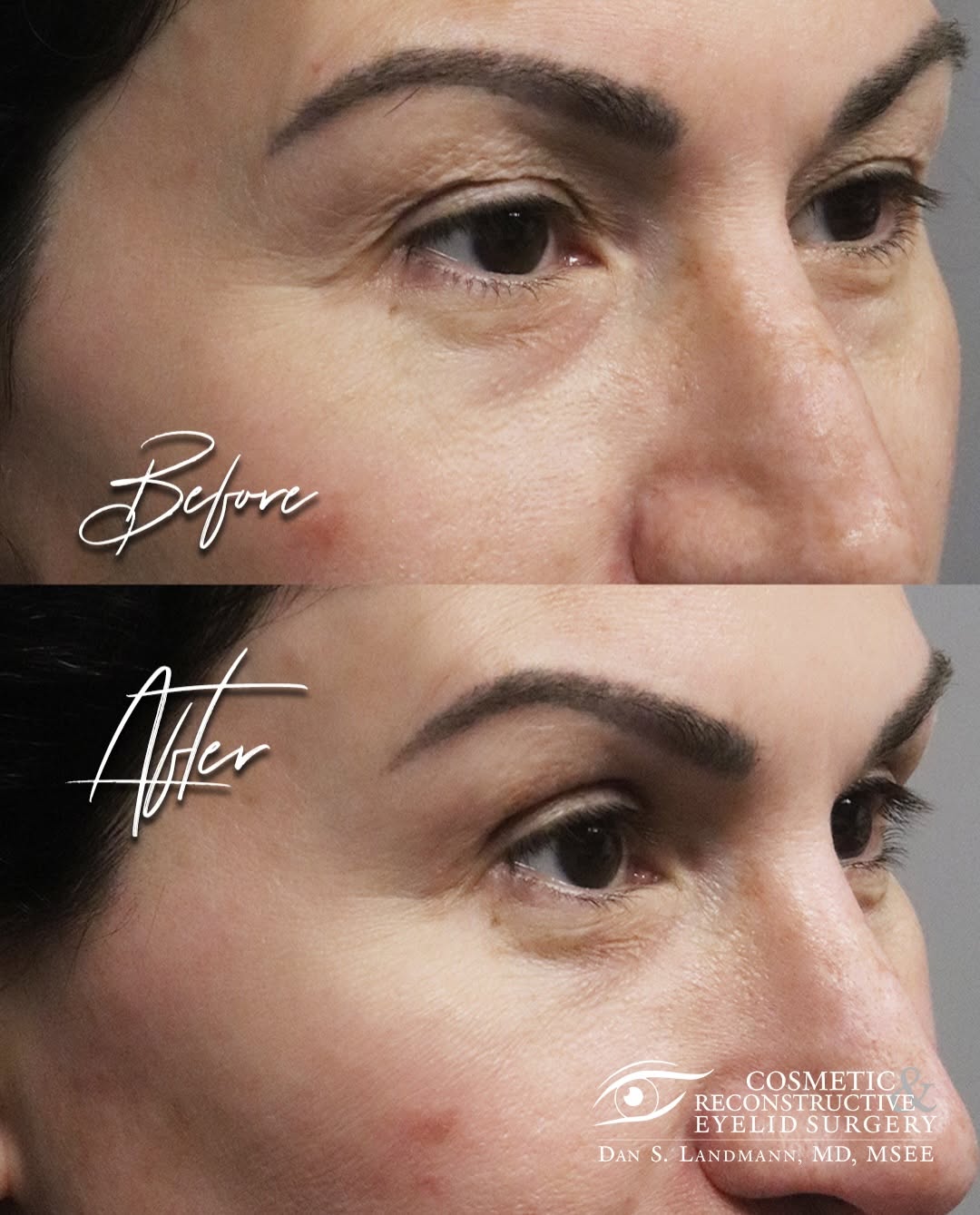 Instagram post by Dr. Dan Landmann: This lovely lovely patient had a little bit of extra skin on her upper lids and some fat pouching out on her lower lids. I did an Upper Lid …