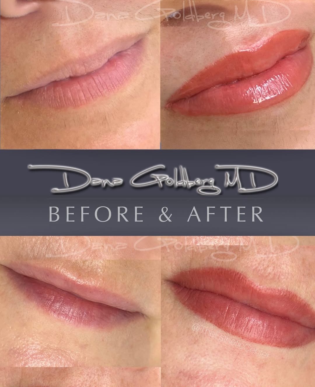 Instagram post by Dr. Dana Goldberg: No lipstick. No liner. No smudging. Lip blushing is a subtle form of permanent makeup that restores color, improves shape, and creates natur…