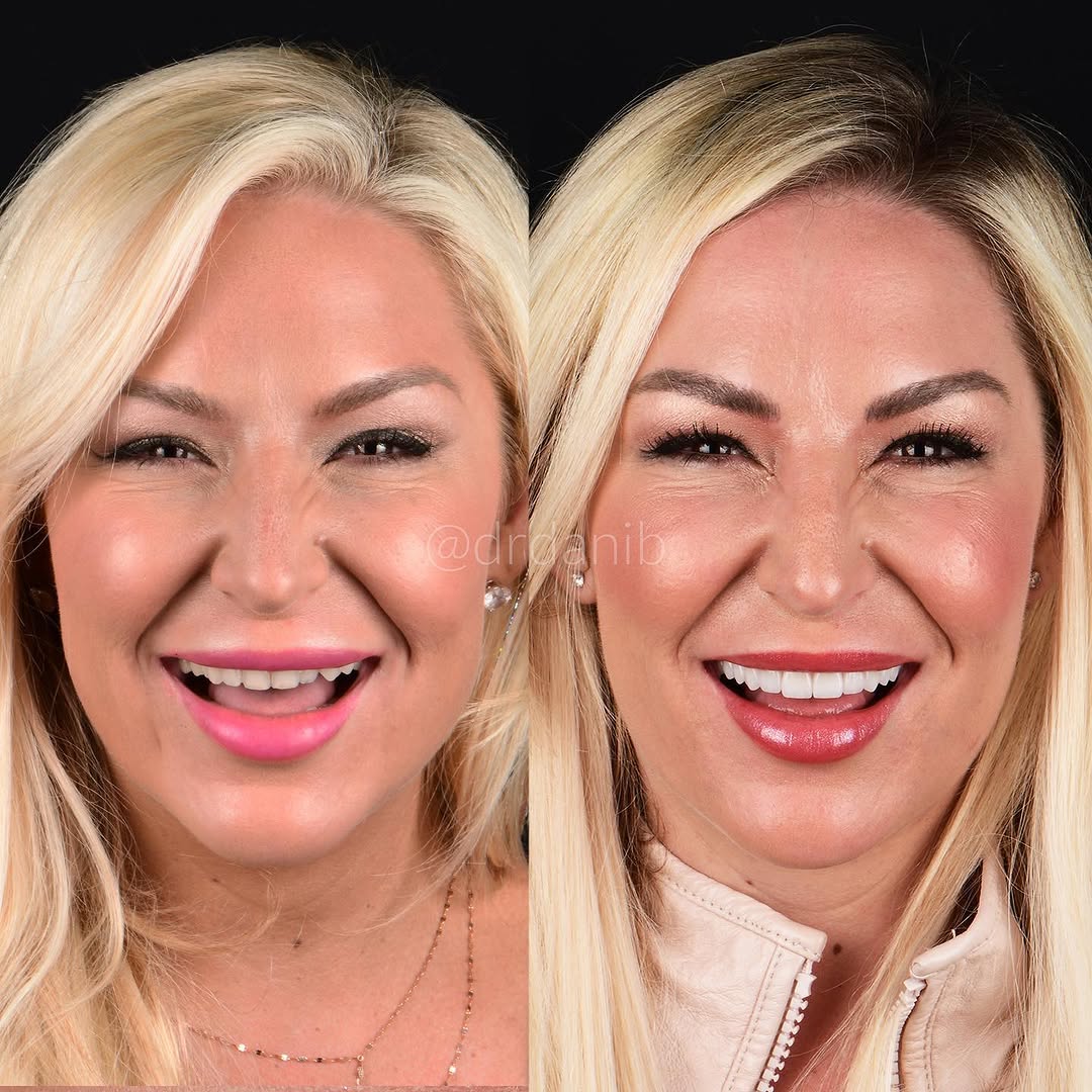 Top teeth porcelain veneers. Porcelain veneers before and after. Beverly Hills cosmetic dentist. Beverly Hills cosmetic dentistry. Los Angeles Hollywood smile. Los Angeles cosmetic dentist. Los Angele